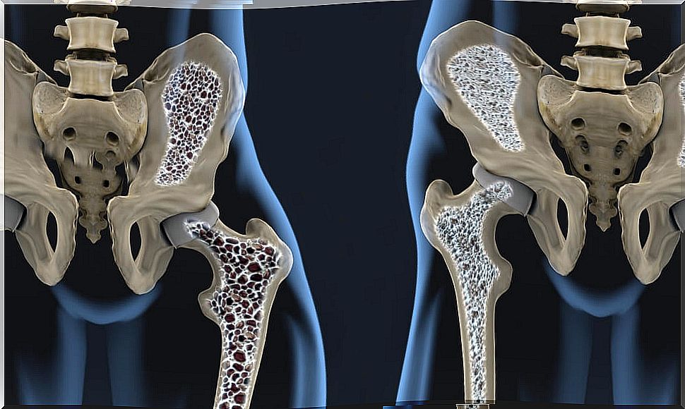 6 tips to prevent osteoporosis with diet