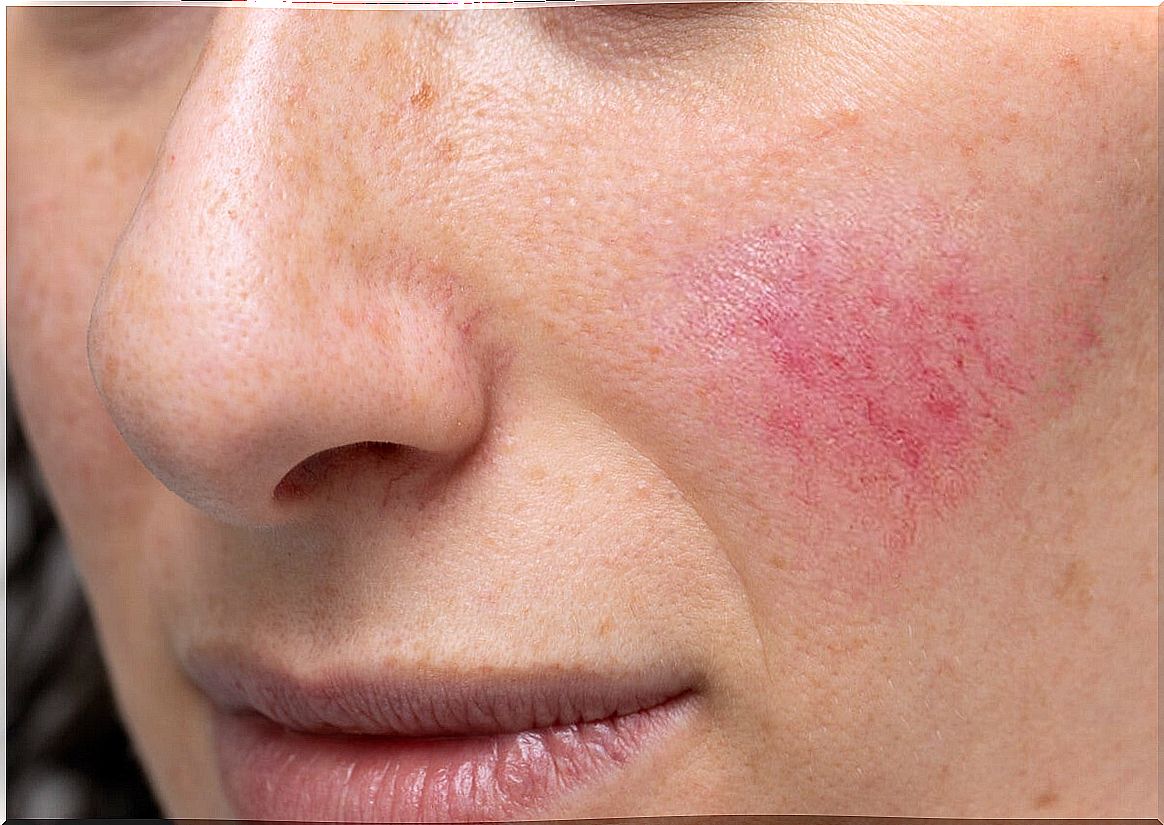 Rosacea on the skin of the cheek