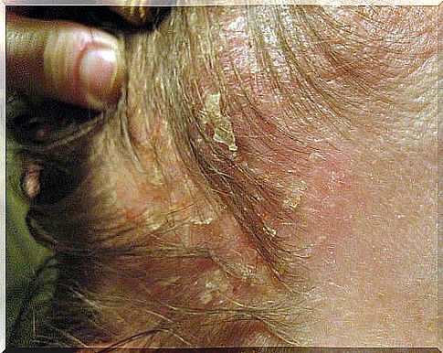 scalp dermatitis