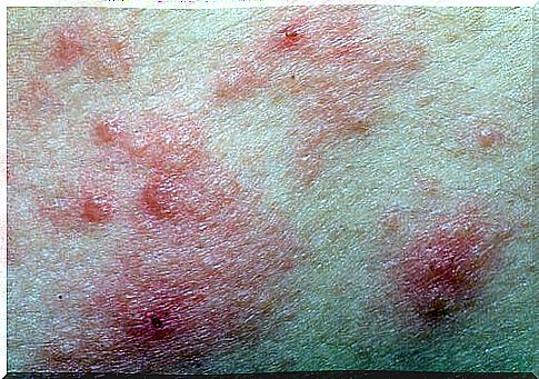 skin dermatitis