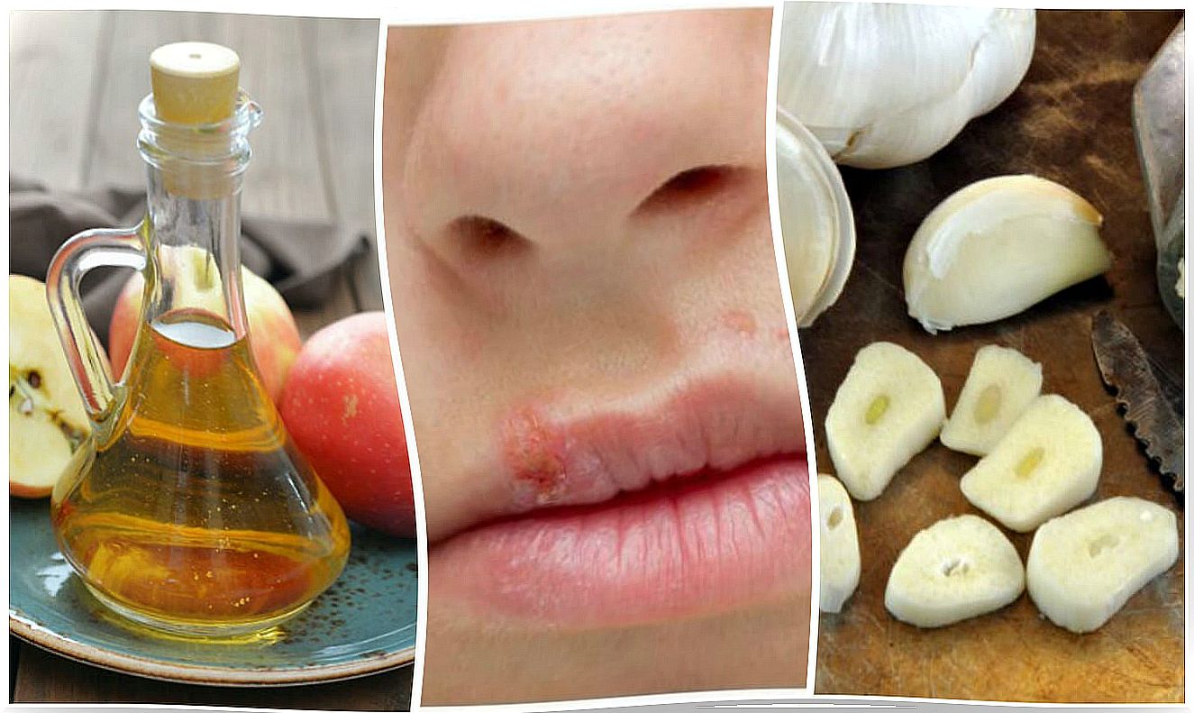 Fight cold sores effectively with these 7 home remedies