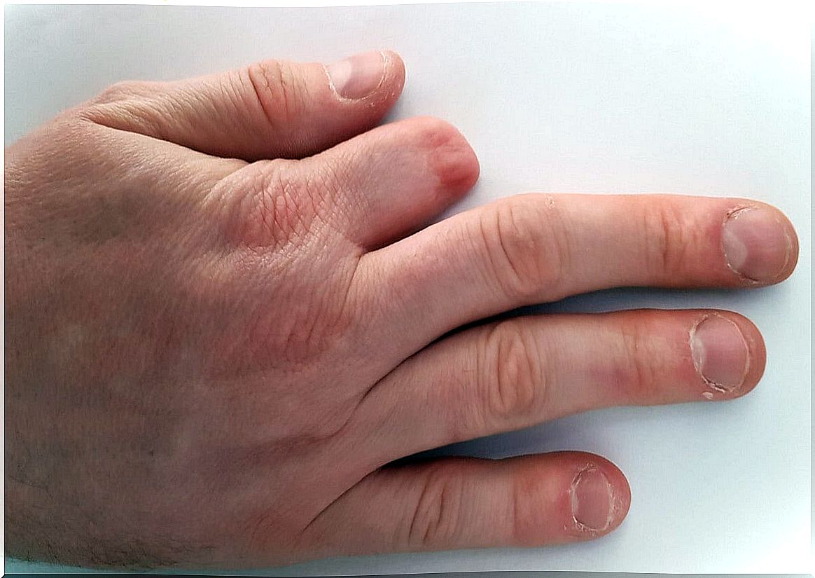 Hand with amputated finger.