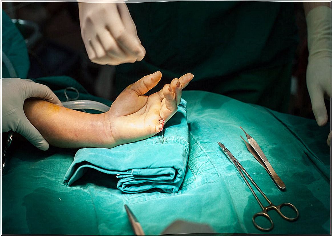 Surgery for accidental amputation of a finger.