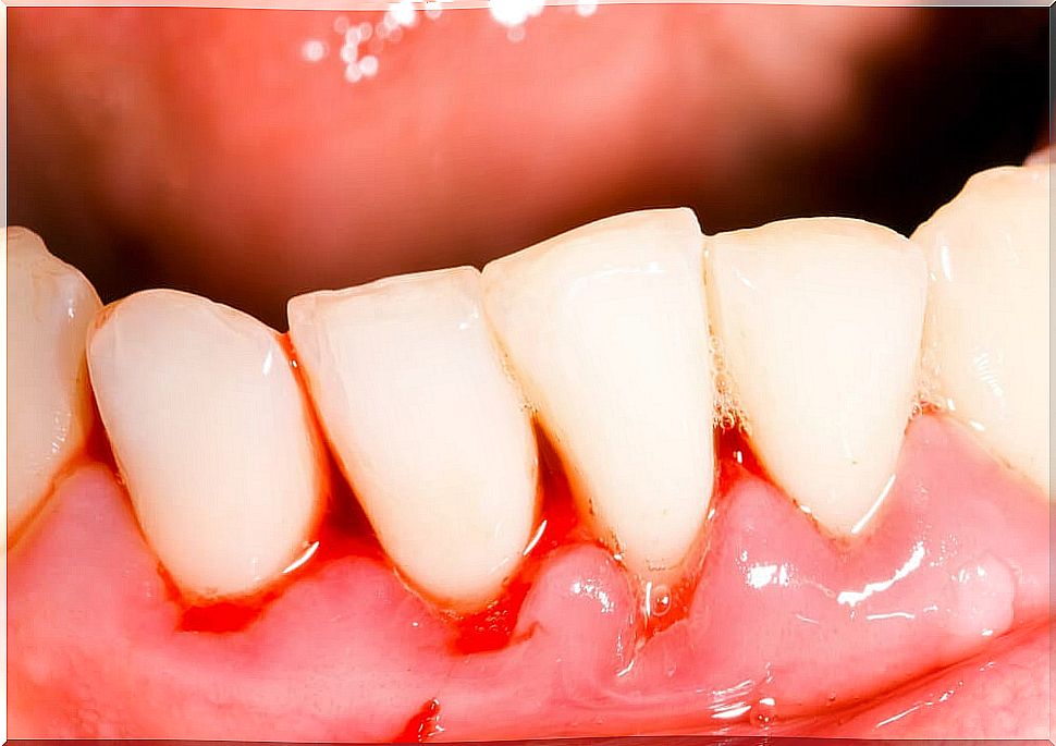 Why gingivitis occurs