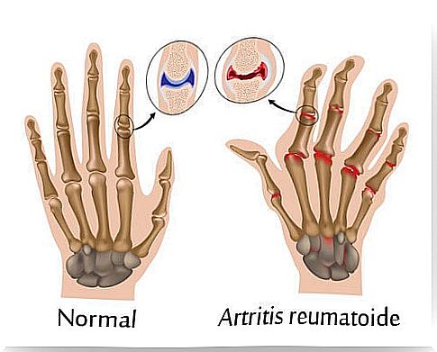 rheumatoid arthritis