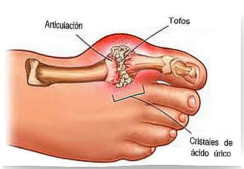 Representation of foot with gout disease