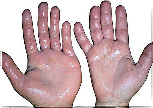 Excessive sweating hands