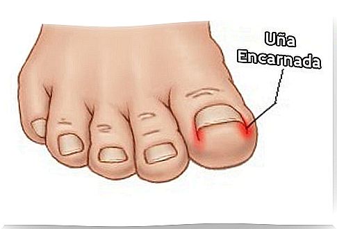 Ingrown toenail