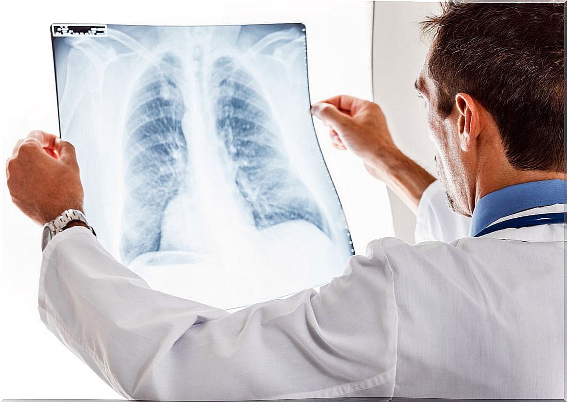 Lung X-ray with chronic bronchitis.