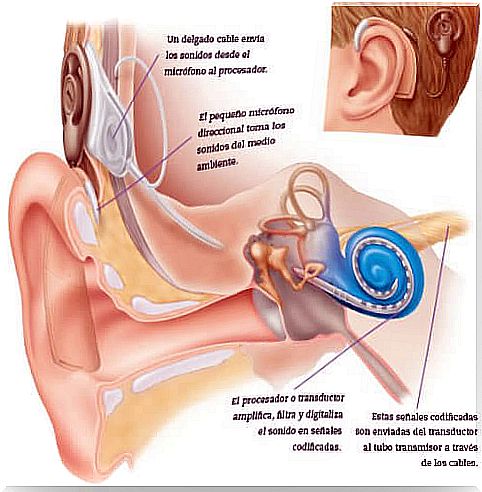 Cochlear implant