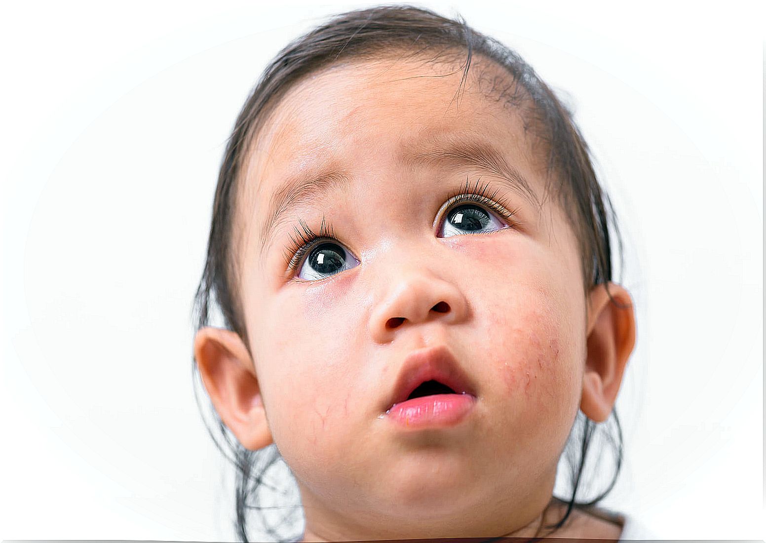 Pityriasis alba is common in children.