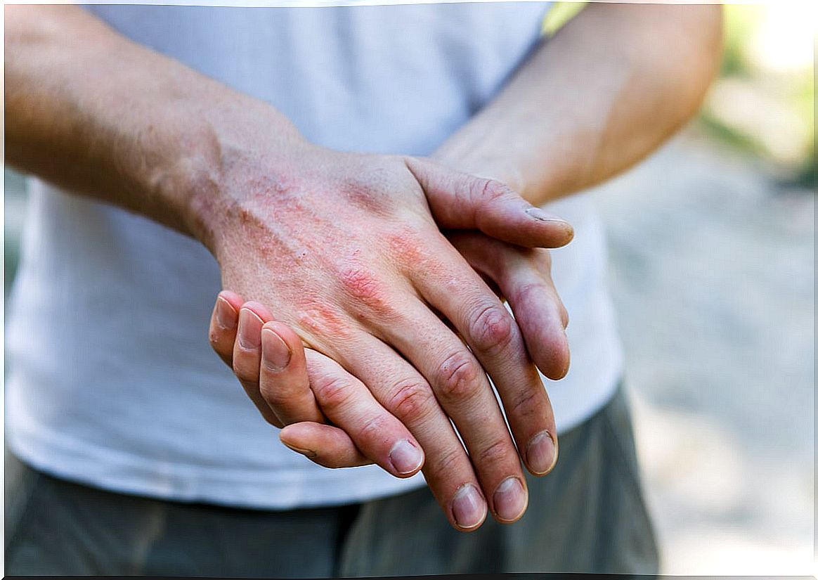 Swimmer's itch in the hands.