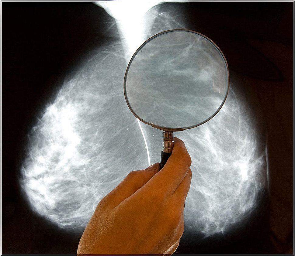 Breast x-ray examination