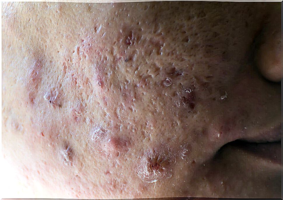 Cystic acne